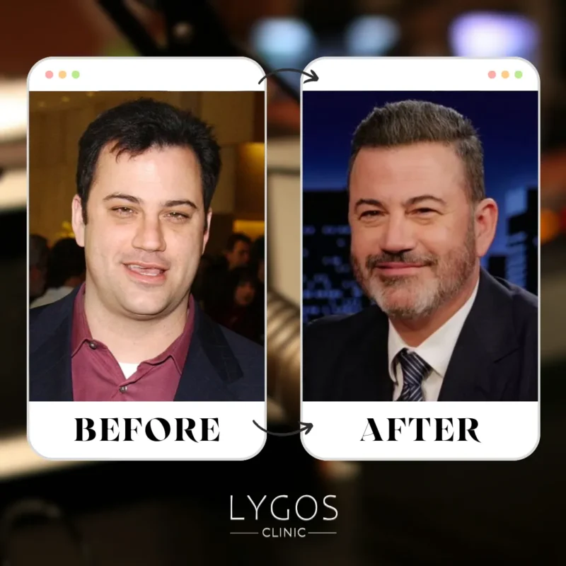 Jimmy Kimmel Hair Transplant