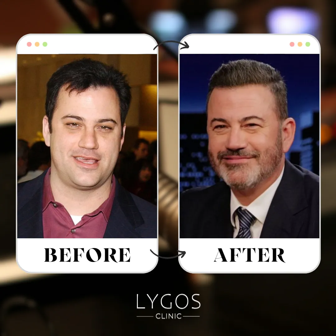 Jimmy Kimmel Hair Transplant | Before and After | LYGOS 2025 1 Jimmy Kimmel Hair Transplant