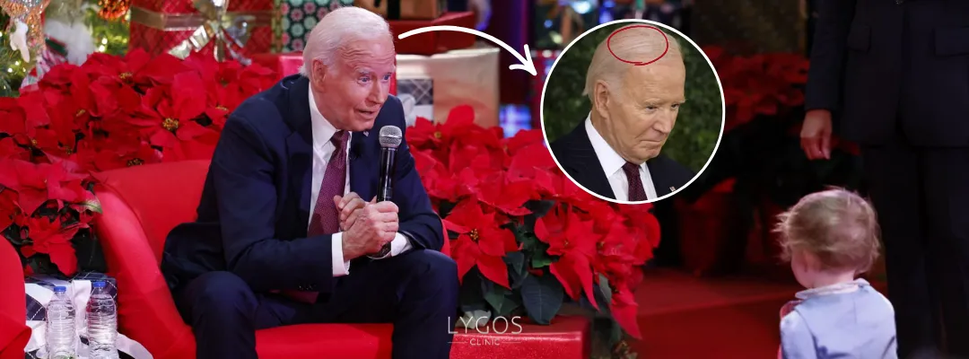 Joe Biden Hair Loss Timeline