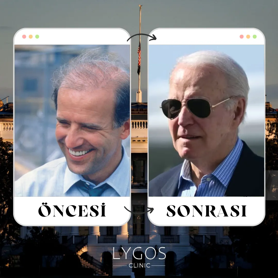 Joe Biden Saç Ekimi | Öncesi ve Sonrası | LYGOS 2025 1 Joe Biden Saç Ekimi