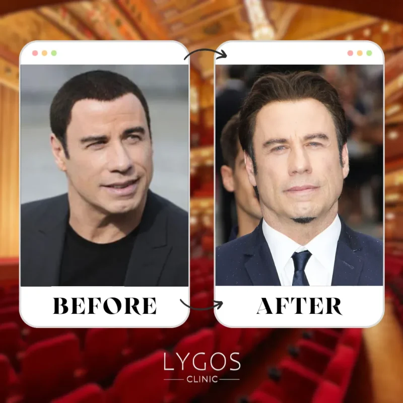 John Travolta Hair Transplant