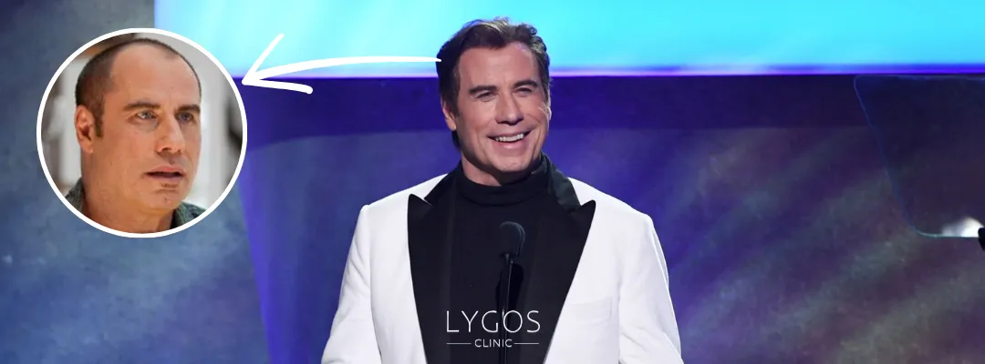 John Travolta Saç Dökülmesi