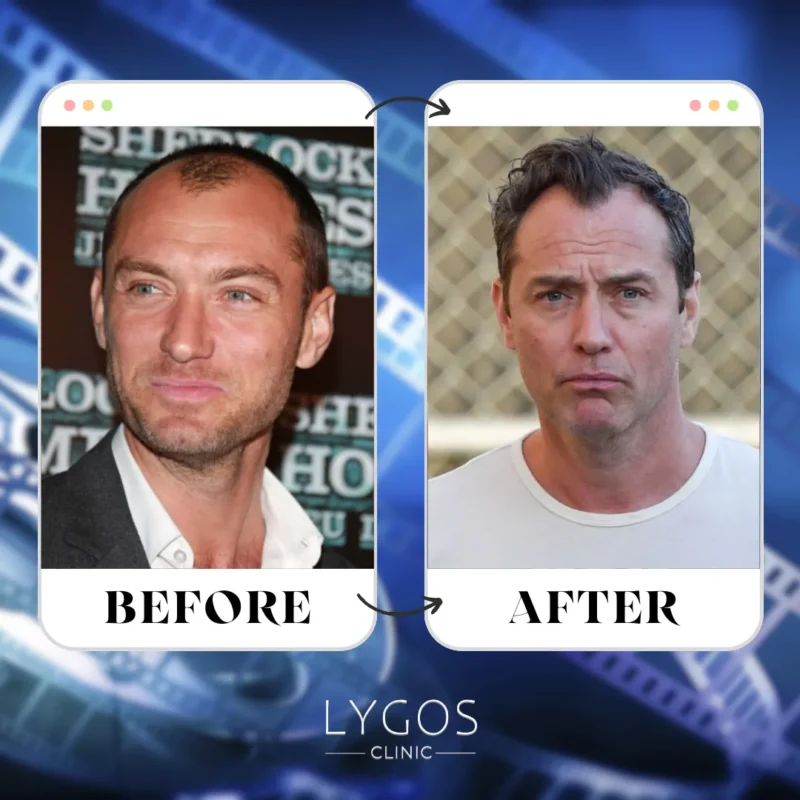 Jude Law Hair Transplant