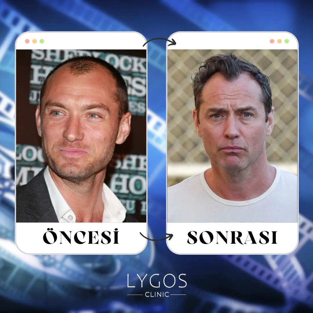 Jude Law Saç Ekimi | Öncesi ve Sonrası 1 Jude Law Saç Ekimi