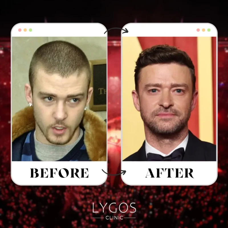 Justin Timberlake Hair Transplant