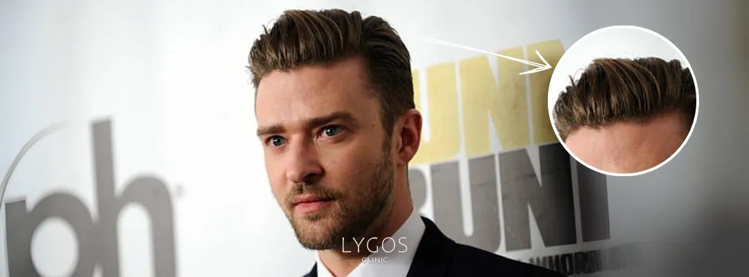 Justin Timberlake Saç Ekimi Yaptırdı mı?