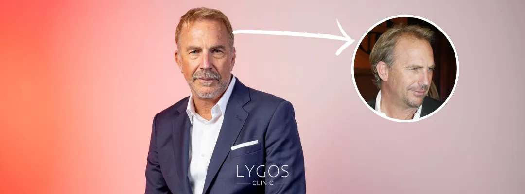 Kevin Costner Saç Dökülmesi