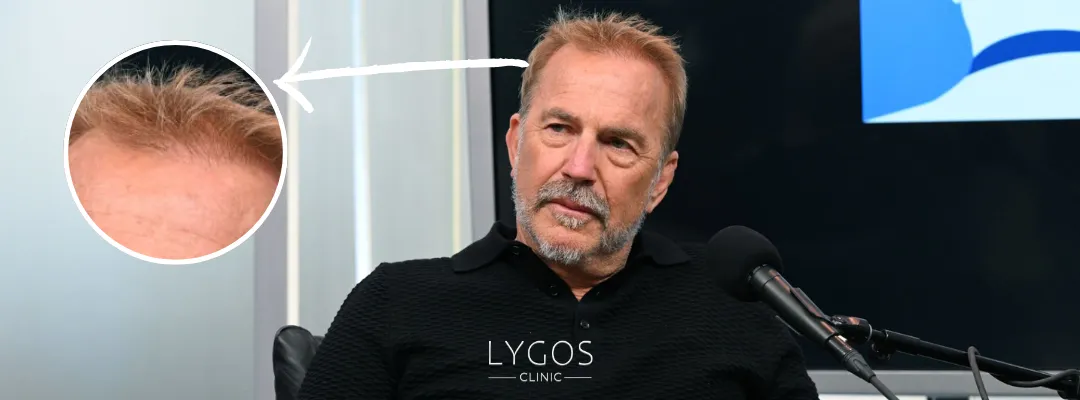 Kevin Costner Saç Ekimi Yaptırdı mı?