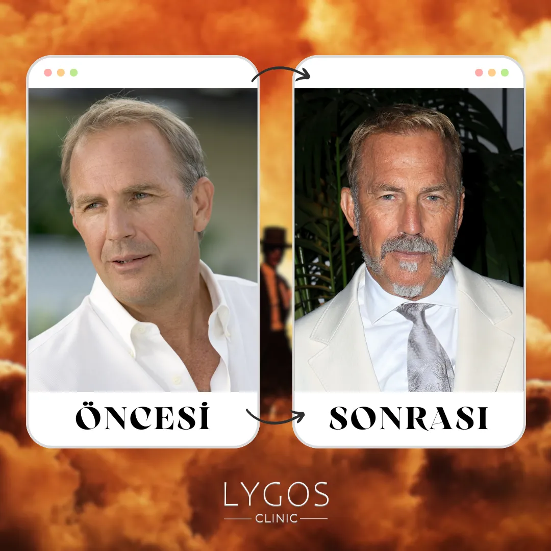 Kevin Costner Saç Ekimi | Öncesi ve Sonrası 1 Kevin Costner Saç Ekimi