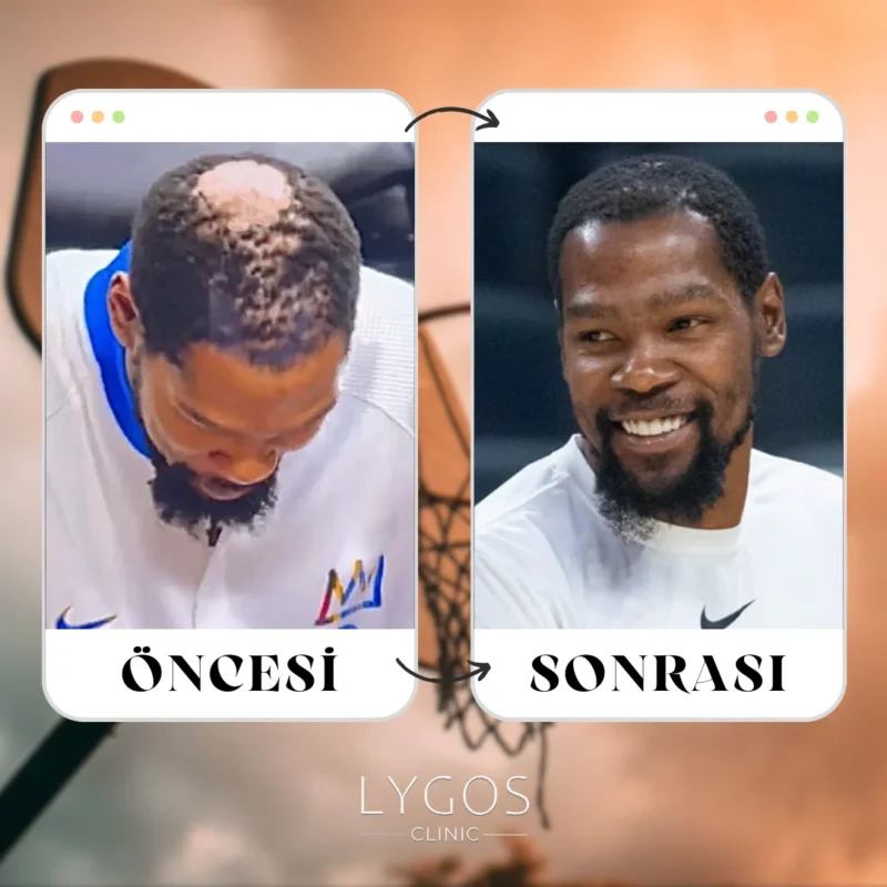 Kevin Durant Saç Ekimi