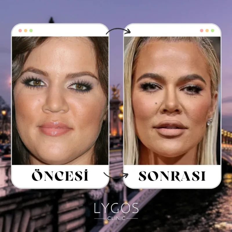 Khloe Kardashian Burun Estetiği