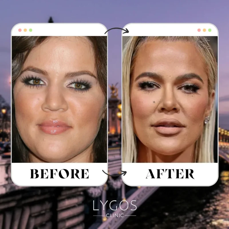 Khloe Kardashian Rhinoplasty