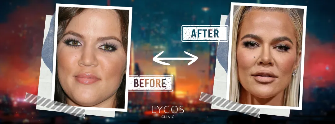 Khloe Kardashian Rhinoplasty Before and After