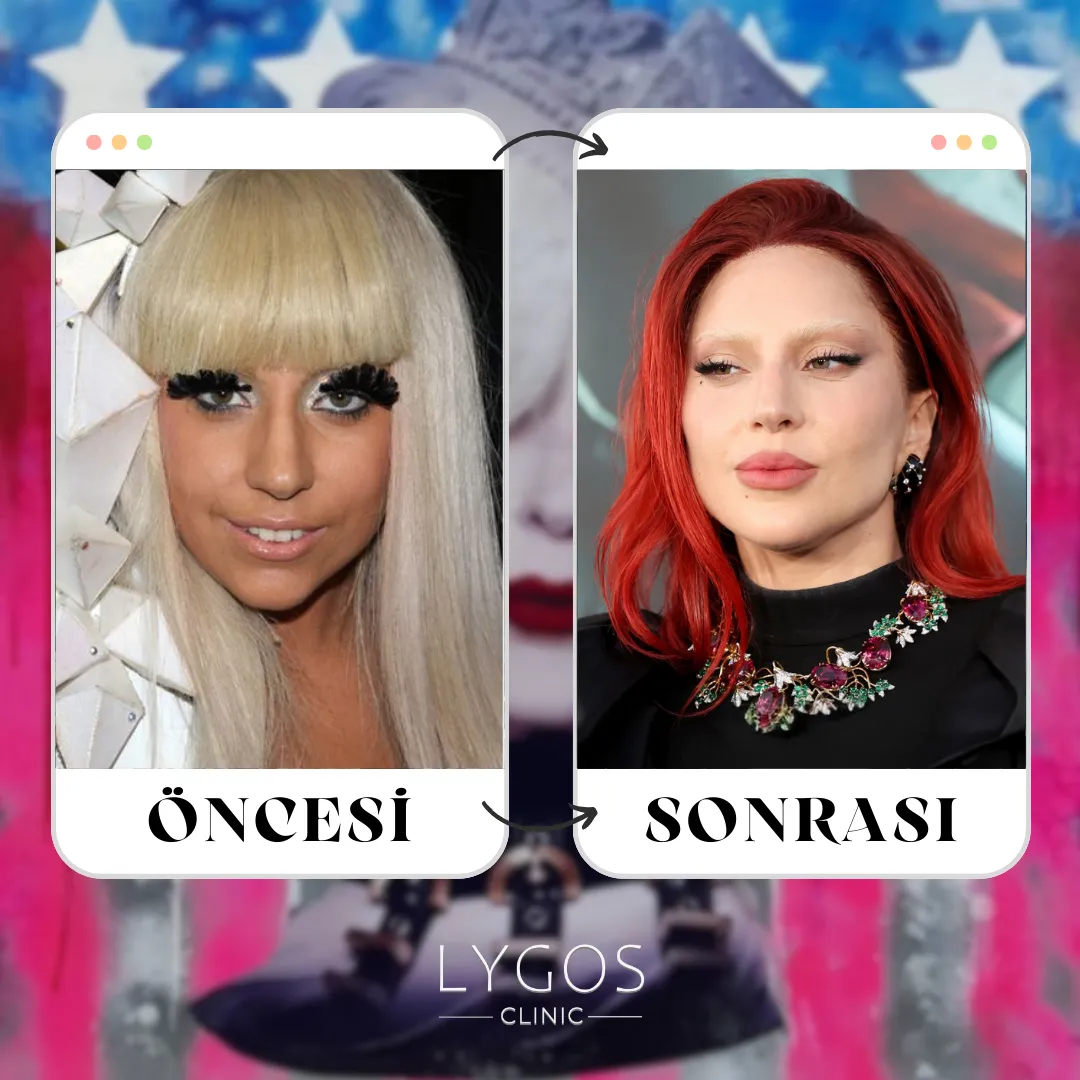 Lady Gaga Burun Estetiği | Ünlülerde Burun Estetiği 1 Lady Gaga Burun Estetiği TR