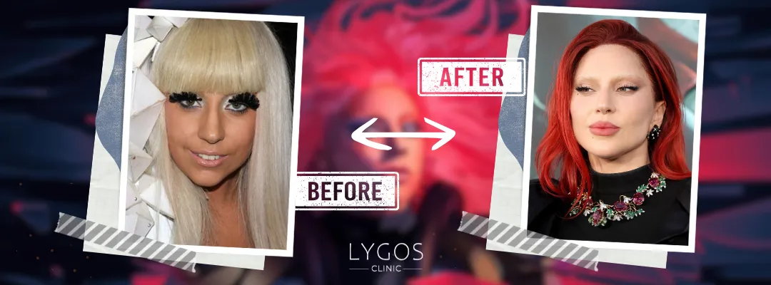 Lady Gaga Rhinoplasty Before and After