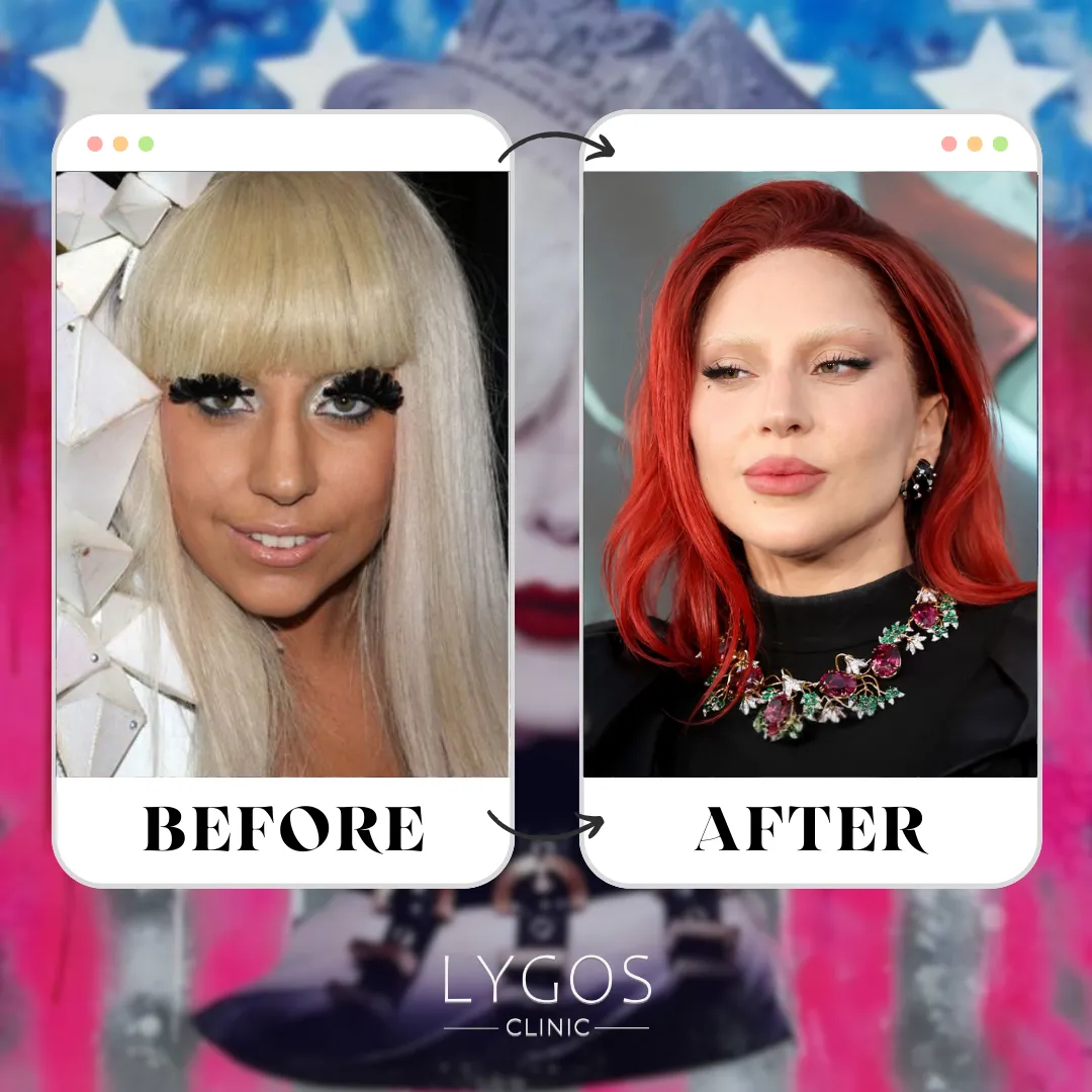 Lady Gaga Rhinoplasty | Celebrities Nose Job 1 Lady Gaga Rhinoplasty