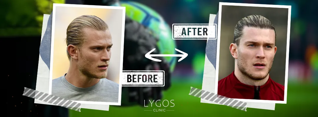 Loris Karius Before and After Hair Transplant