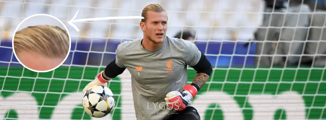 Loris Karius Hair Loss