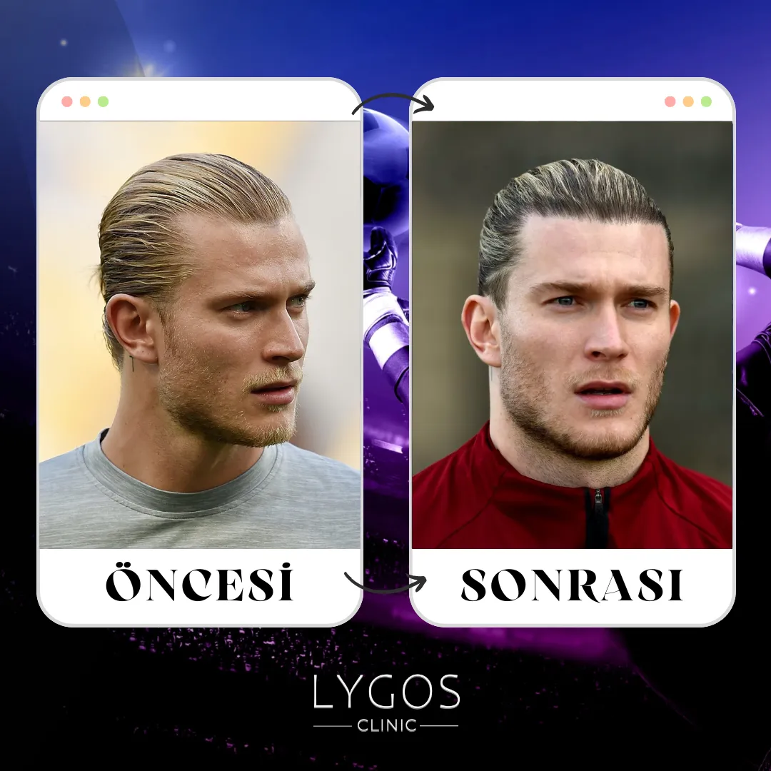 Loris Karius Saç Ekimi | Ünlülerde Saç Ekimi 1 Loris Karius Saç Ekimi
