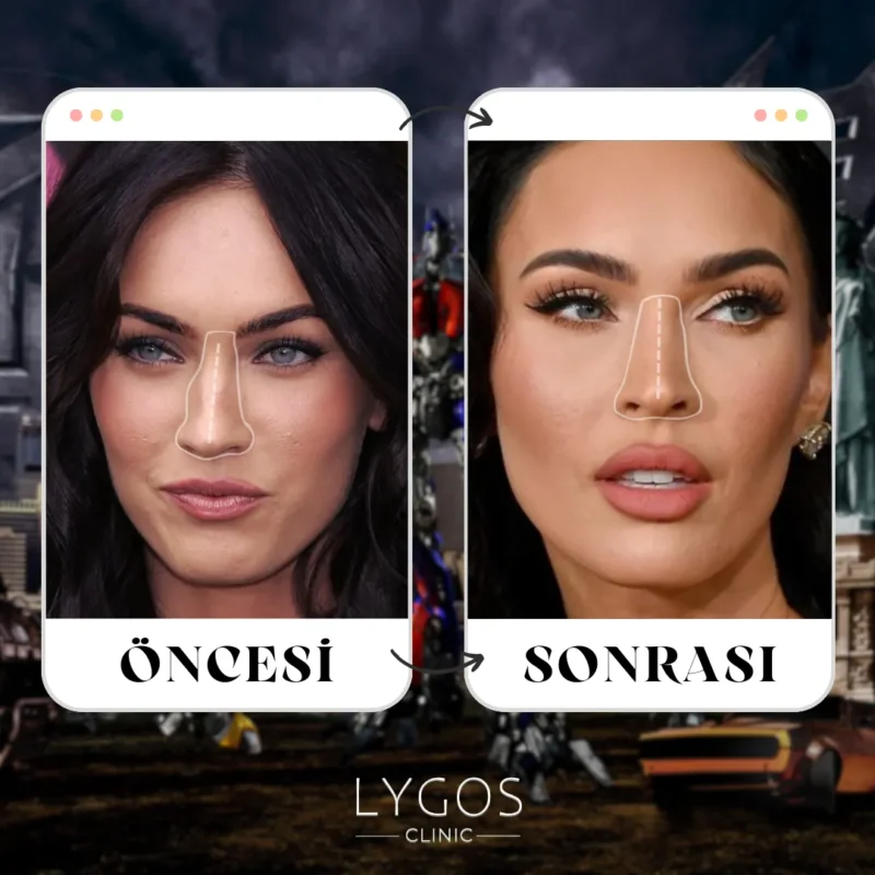 Megan Fox Burun Estetiği Rinoplasti