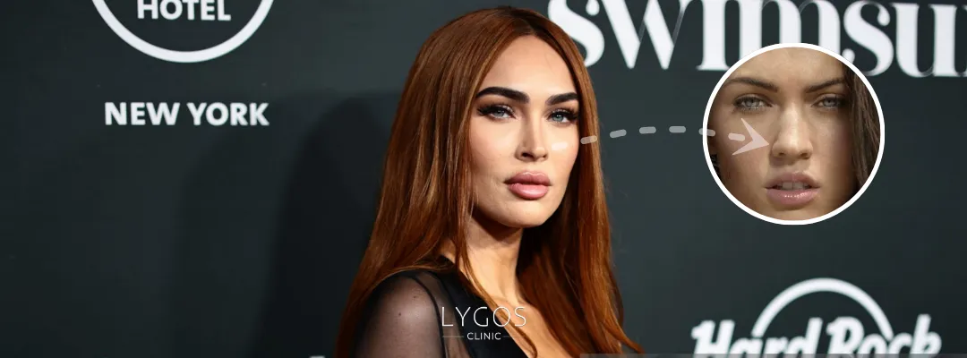 Megan Fox Burun Estetiği Yaptırdı mı?