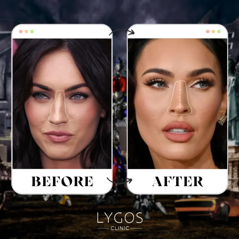 Megan Fox Rhinoplasty (Nose Job)