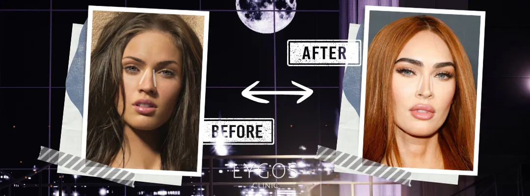 Megan Fox Rhinoplasty Before and After