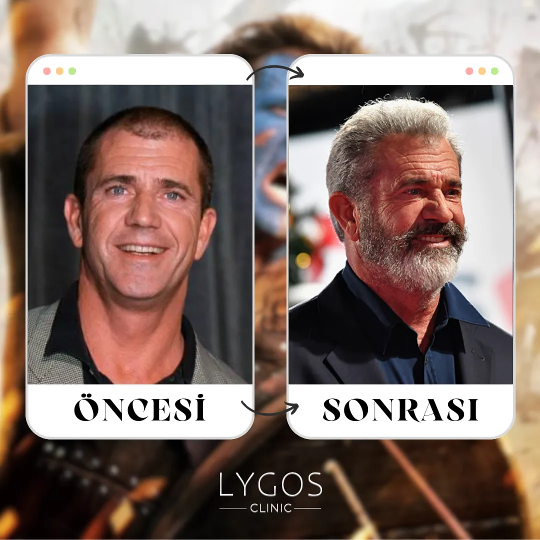 Mel Gibson Saç Ekimi