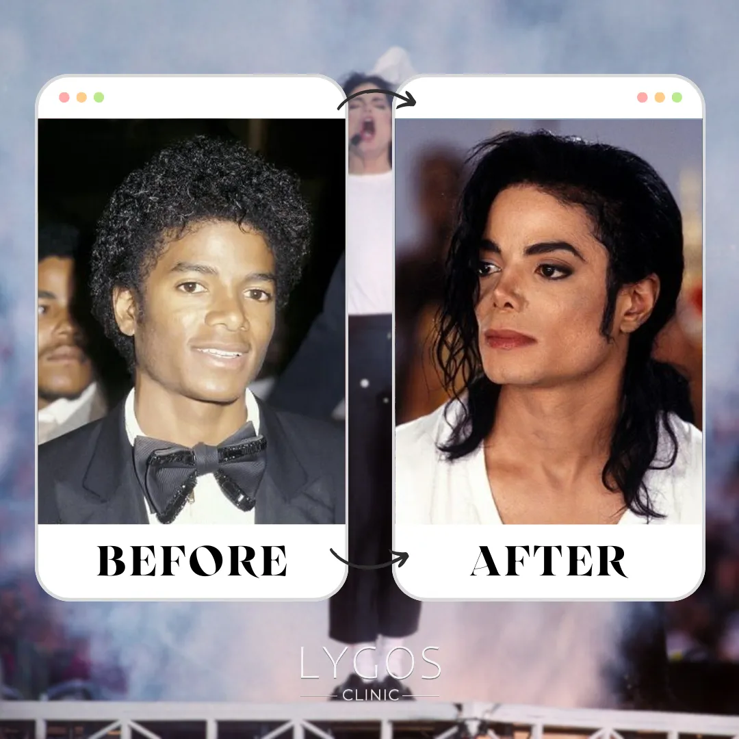 Michael Jackson Rhinoplasty | Celebrities Nose Job 1 Michael Jackson Rhinoplasty