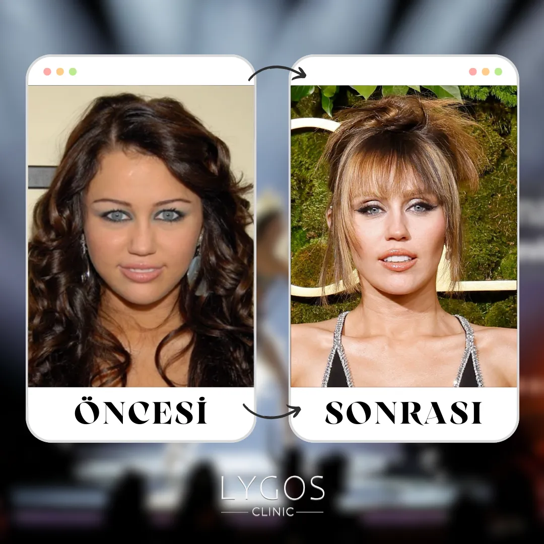 Miley Cyrus Burun Estetiği | Ünlülerde Burun Estetiği 1 Miley Cyrus Burun Estetiği
