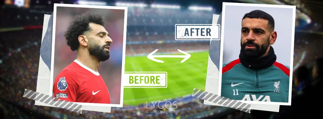 Mohamed Salah Before and After Hair Transplant