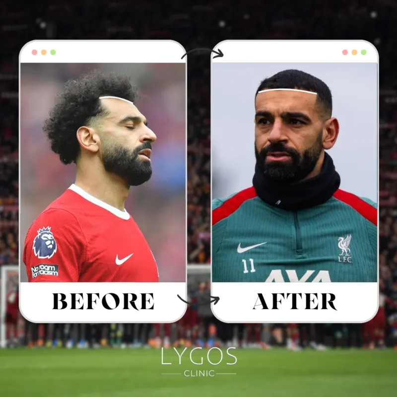 Mohamed Salah Hair Transplant