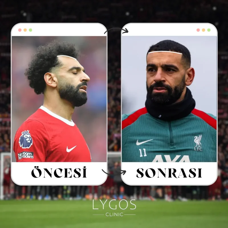 Mohamed Salah Saç Ekimi