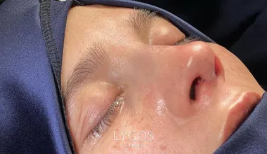 piezo rhinoplasty landing