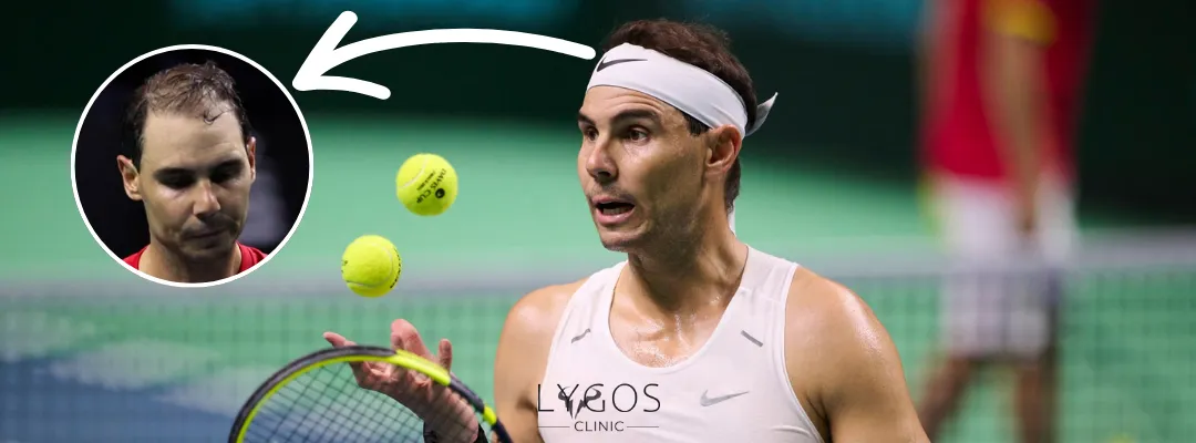 Rafael Nadal Hair Loss