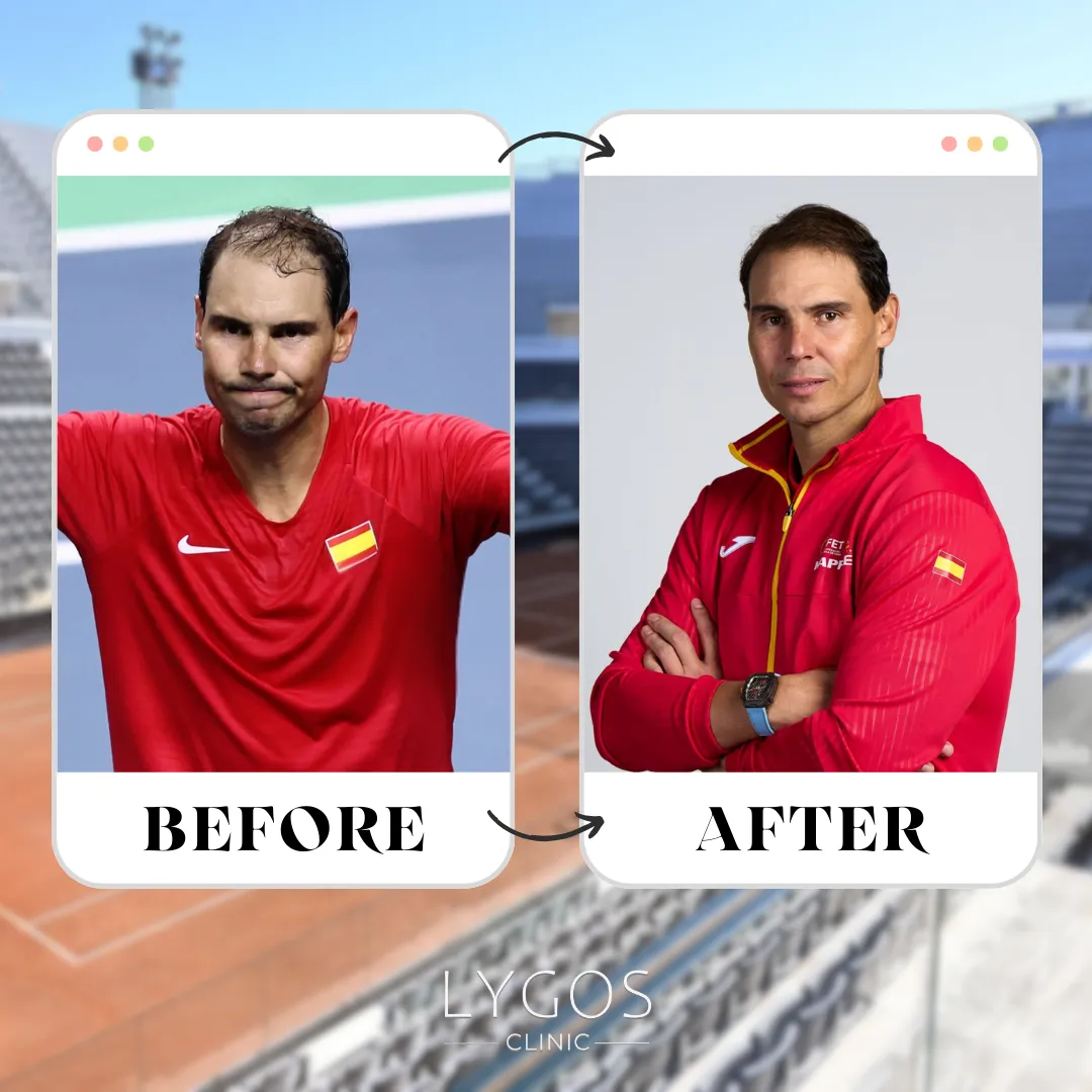 Rafael Nadal Hair Transplant | Before and After | LYGOS 2025 1 Rafael Nadal Hair Transplant