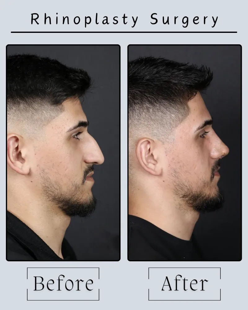 Rhinoplasty Landing Page 17 Rhinoplasty Before After 1