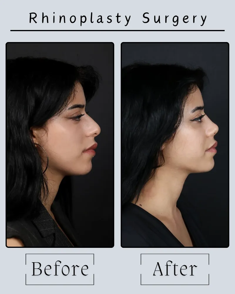 Rhinoplasty Landing Page 18 Rhinoplasty Before After 2
