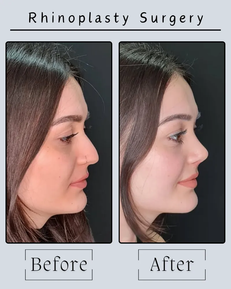 Rhinoplasty Landing Page 19 Rhinoplasty Before After 3