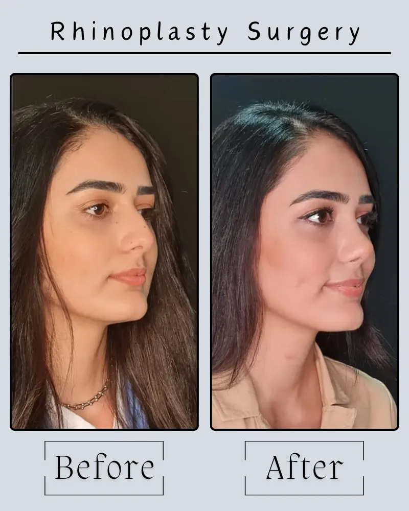 Rhinoplasty Landing Page 20 Rhinoplasty Before After 4