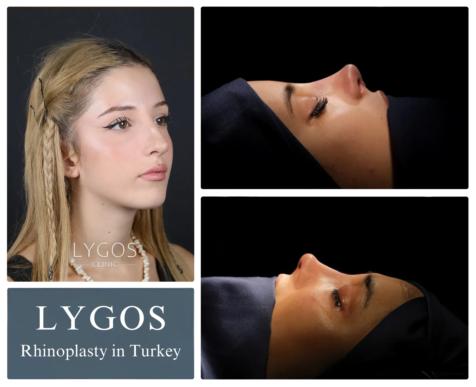 rhinoplasty in turkey