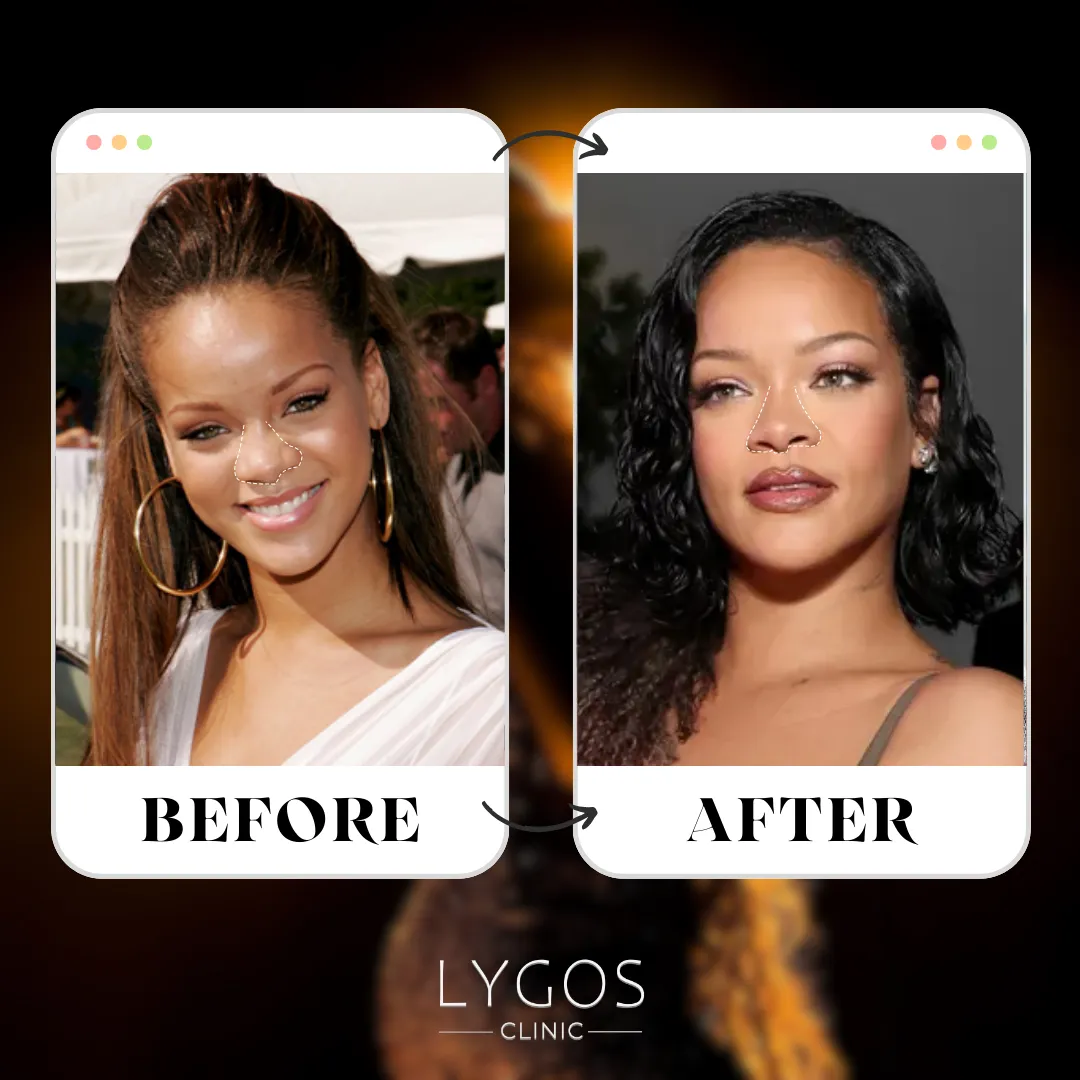 Rihanna Rhinoplasty | Celebrities Nose Job 1 Rihanna Rhinoplasty