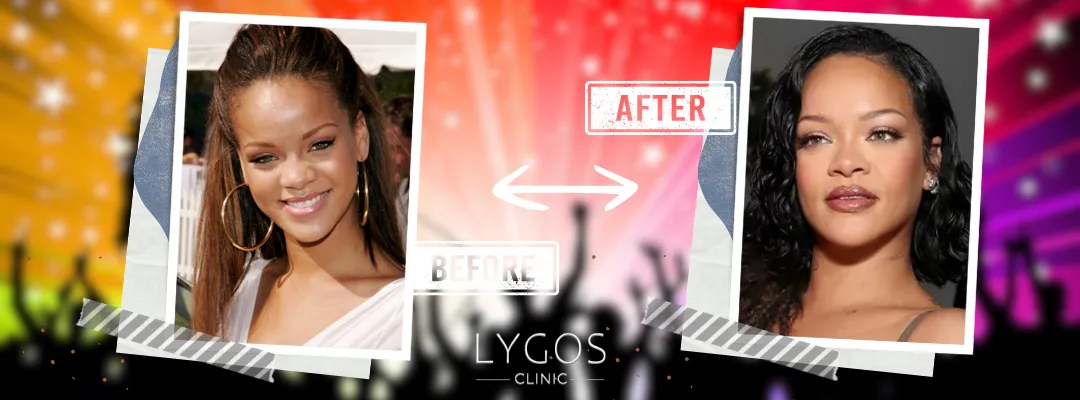 Rihanna Rhinoplasty Before and After