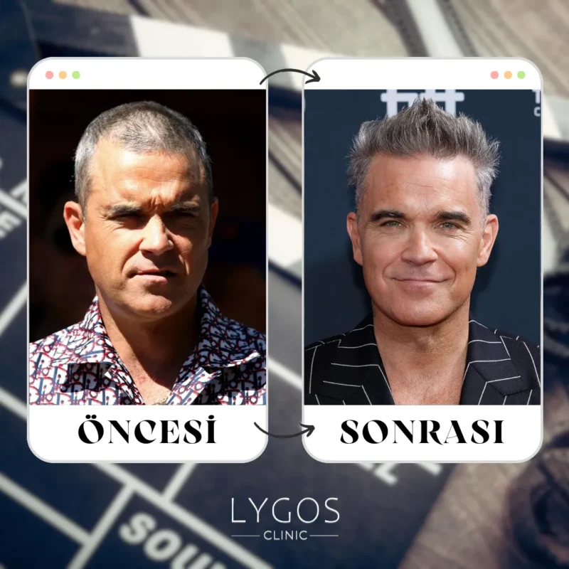Robbie Williams Saç Ekimi
