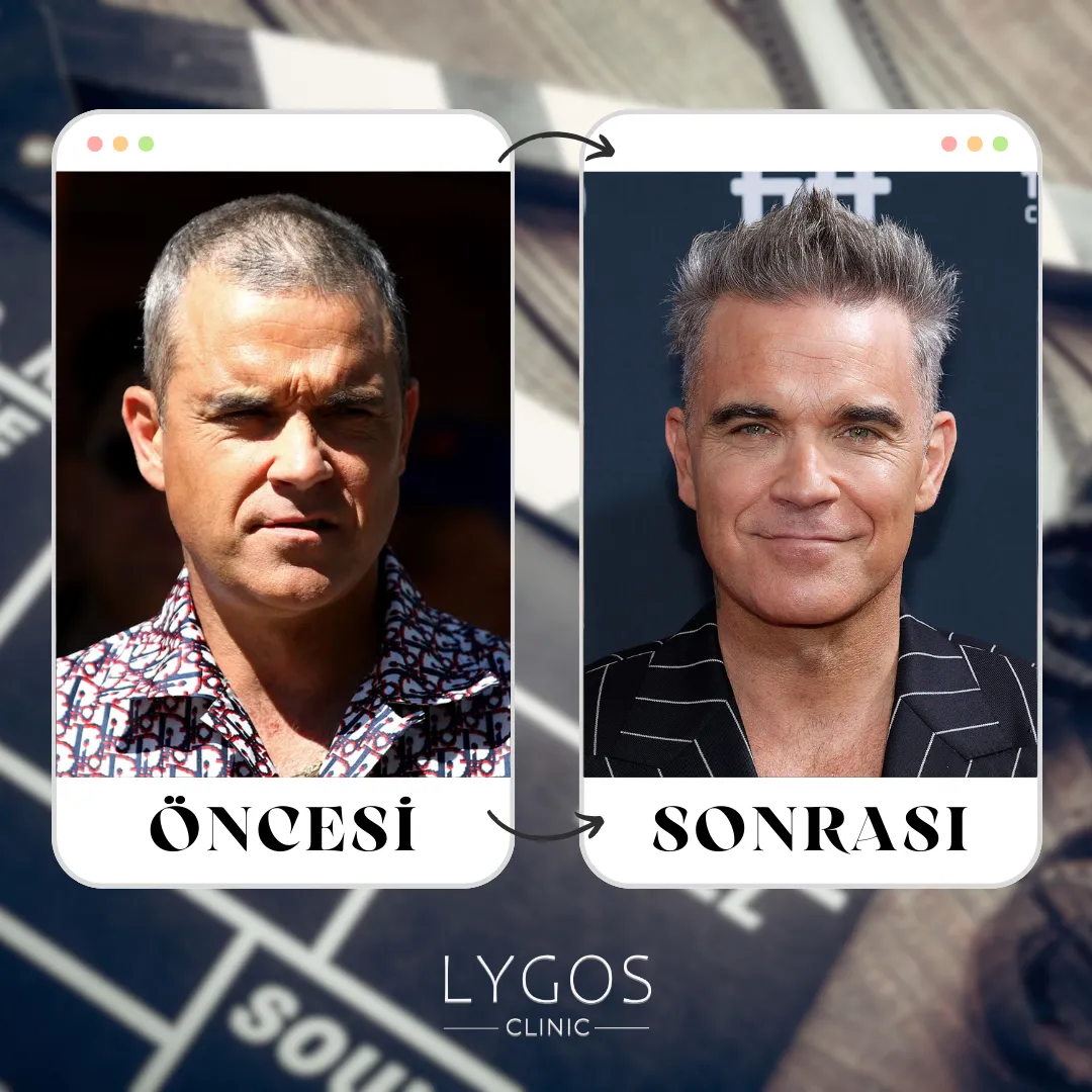 Robbie Williams Saç Ekimi | Ünlülerde Saç Ekimi 1 Robbie Williams Saç Ekimi