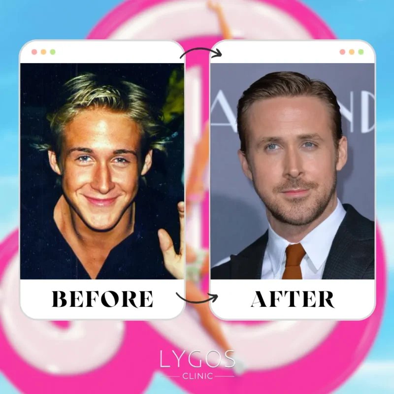 Ryan Gosling Rhinoplasty