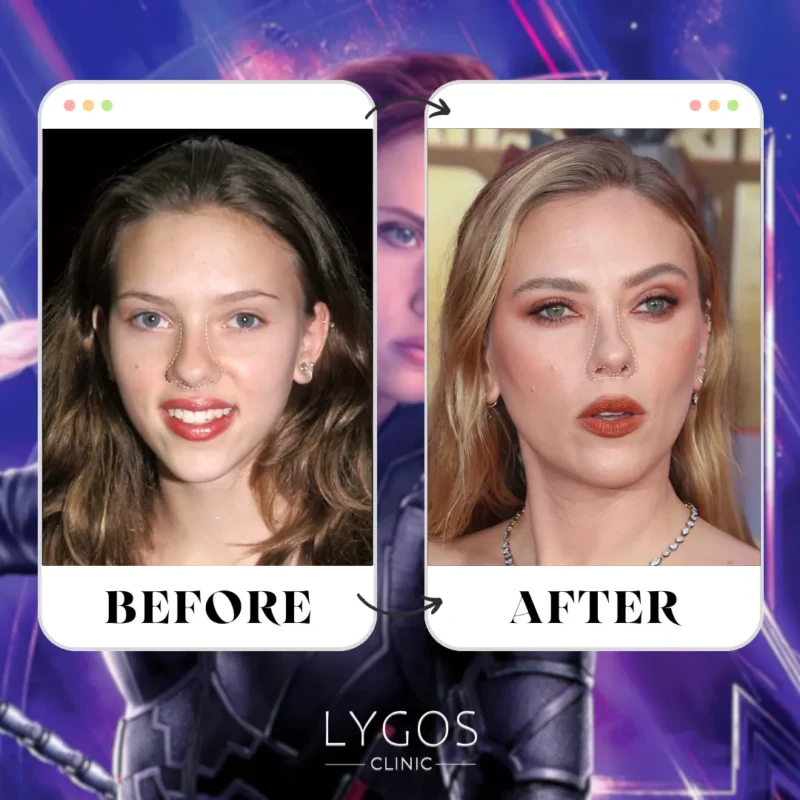 Scarlett Johansson Rhinoplasty
