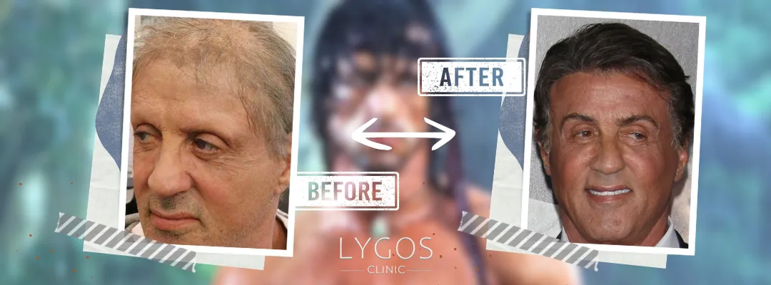 Sylvester Stallone Before and After Hair Transplant