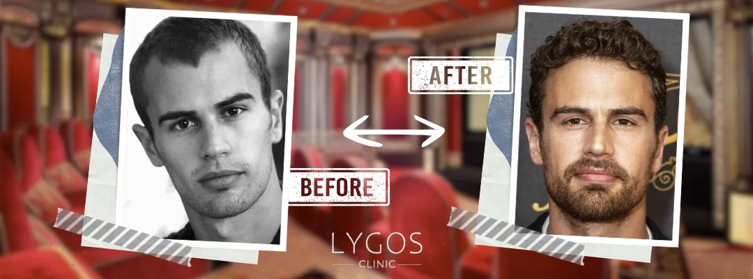 Theo James Before and After Hair Transplant