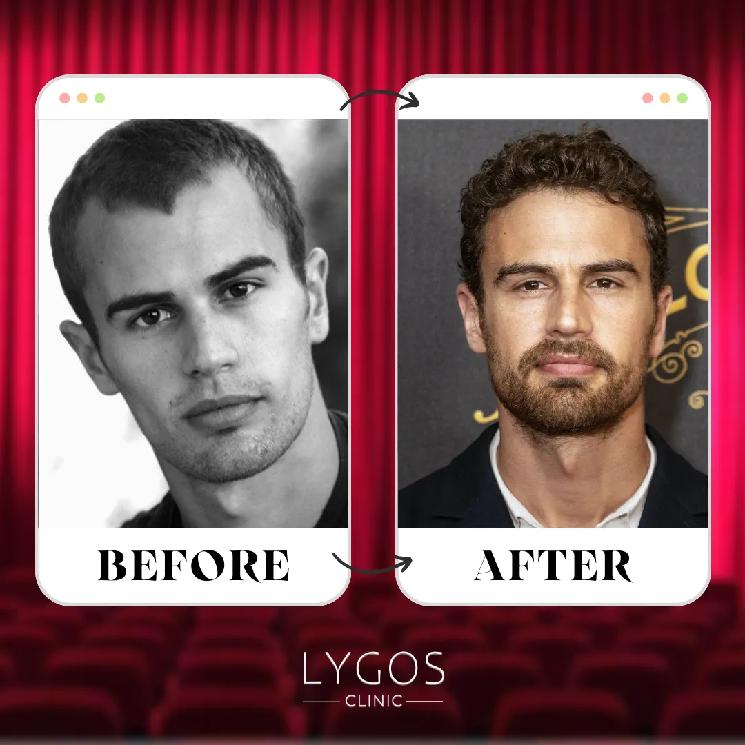 Theo James Hair Transplant | Before and After | LYGOS 2025 1 Theo James Hair Transplant